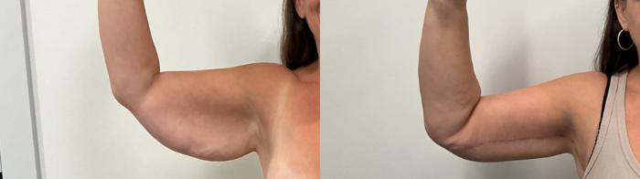 Before & After Arm Lift Case 493 Left Front Side View in Albany, Latham & Saratoga, New York