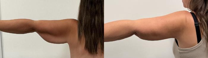 Before & After Arm Lift Case 493 Left Side View in Albany, Latham & Saratoga, New York
