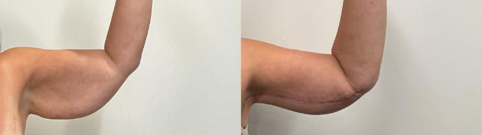 Before & After Arm Lift Case 493 Right Side View in Albany, Latham & Saratoga, New York