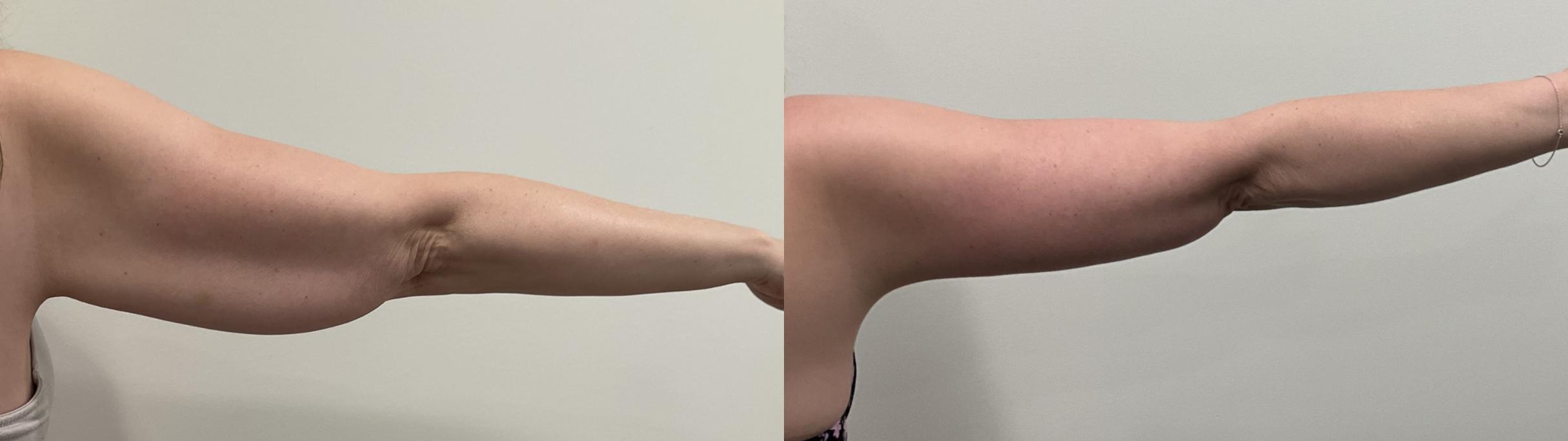 Before & After Arm Lift Case 512 Left Side View in Albany, Latham & Saratoga, New York
