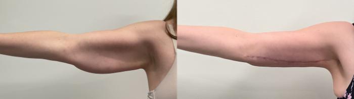 Before & After Arm Lift Case 512 Right Side View in Albany, Latham & Saratoga, New York