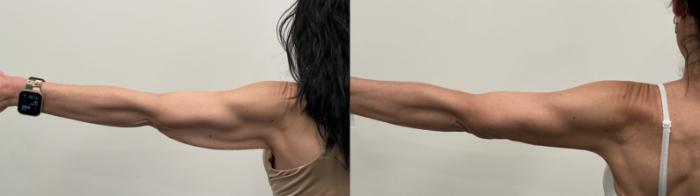 Before & After Arm Lift Case 514 Back View in Albany, Latham & Saratoga, New York