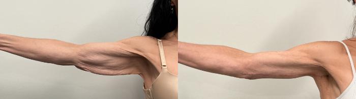 Before & After Arm Lift Case 514 Front View in Albany, Latham & Saratoga, New York