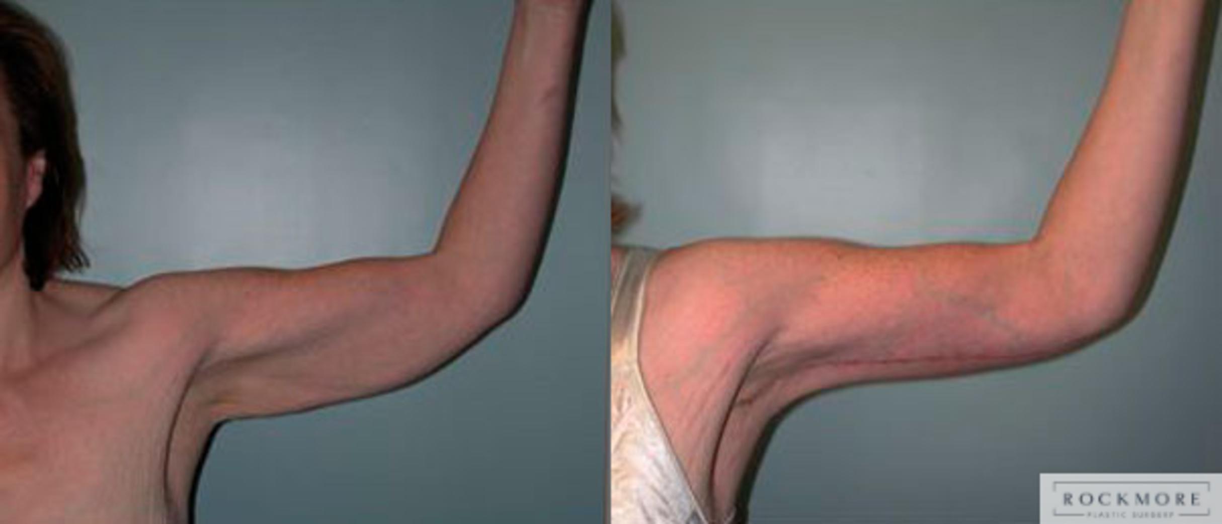Before & After Arm Lift Case 78 View #1 View in Albany & Latham, New York