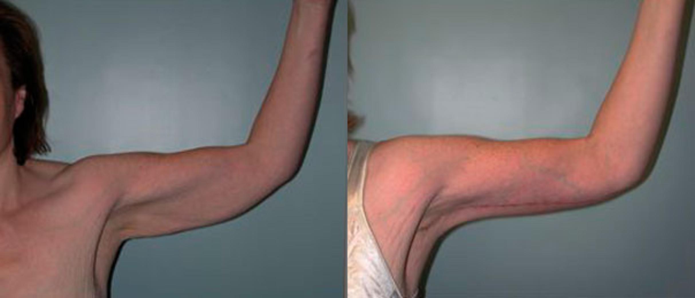 Before & After Arm Lift Case 78 View #1 View in Albany, Latham & Saratoga, New York