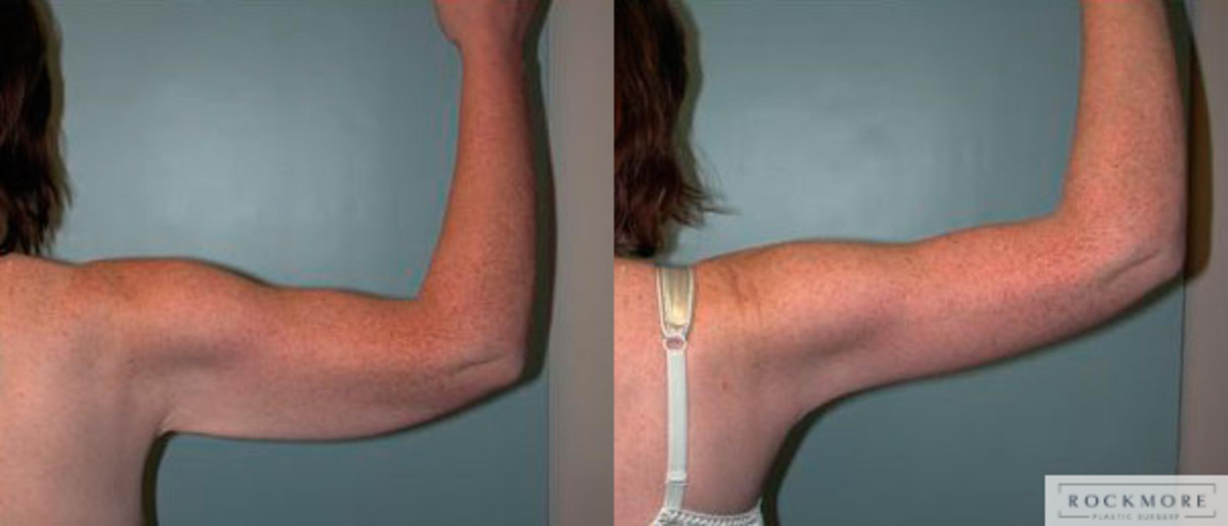 Before & After Arm Lift Case 78 View #2 View in Albany & Latham, New York