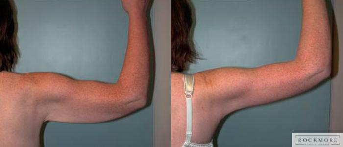 Before & After Arm Lift Case 78 View #2 View in Albany & Latham, New York