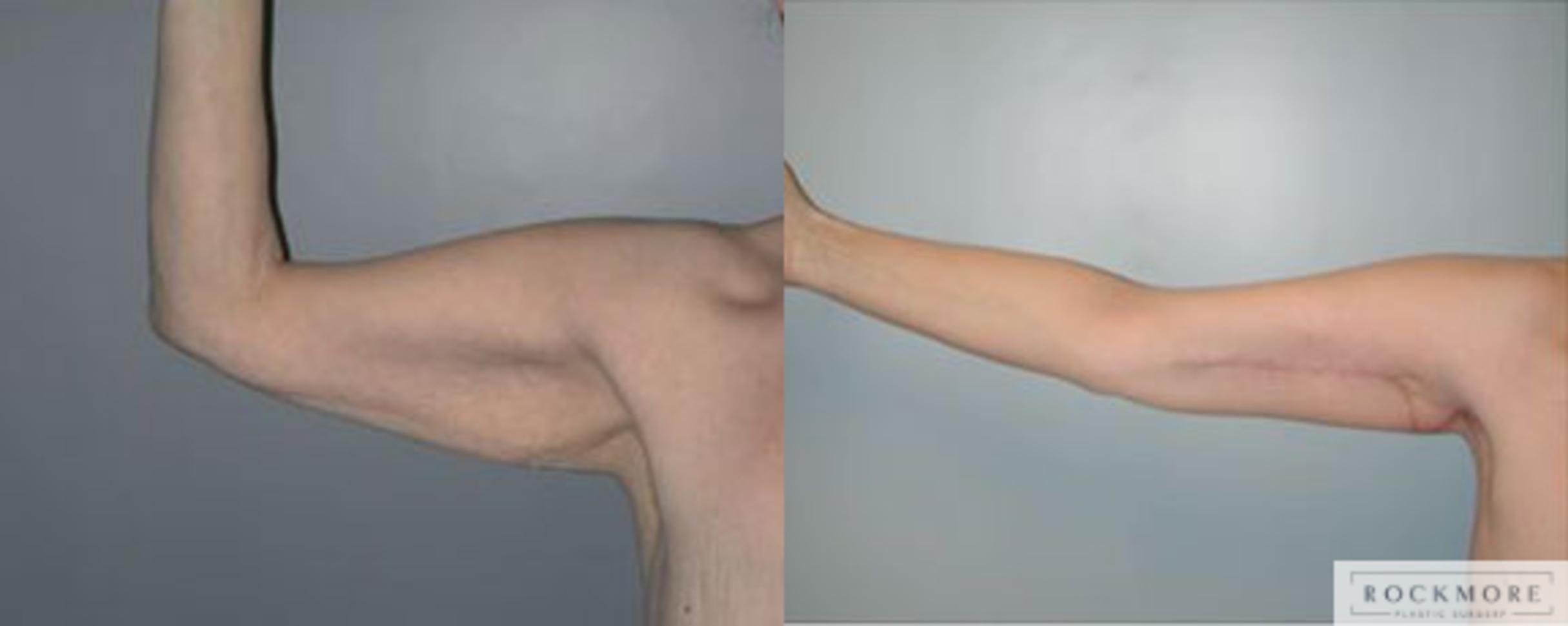 Before & After Arm Lift Case 97 View #1 View in Albany & Latham, New York