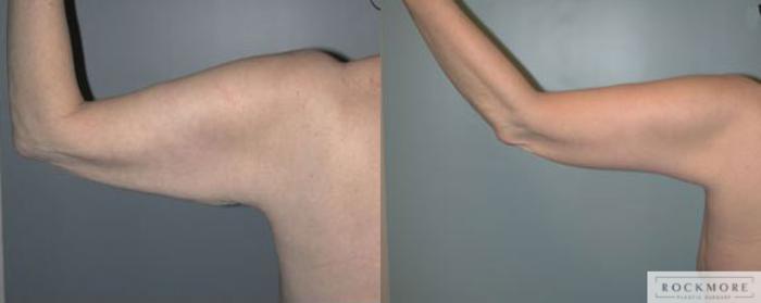 Before & After Arm Lift Case 97 View #2 View in Albany & Latham, New York