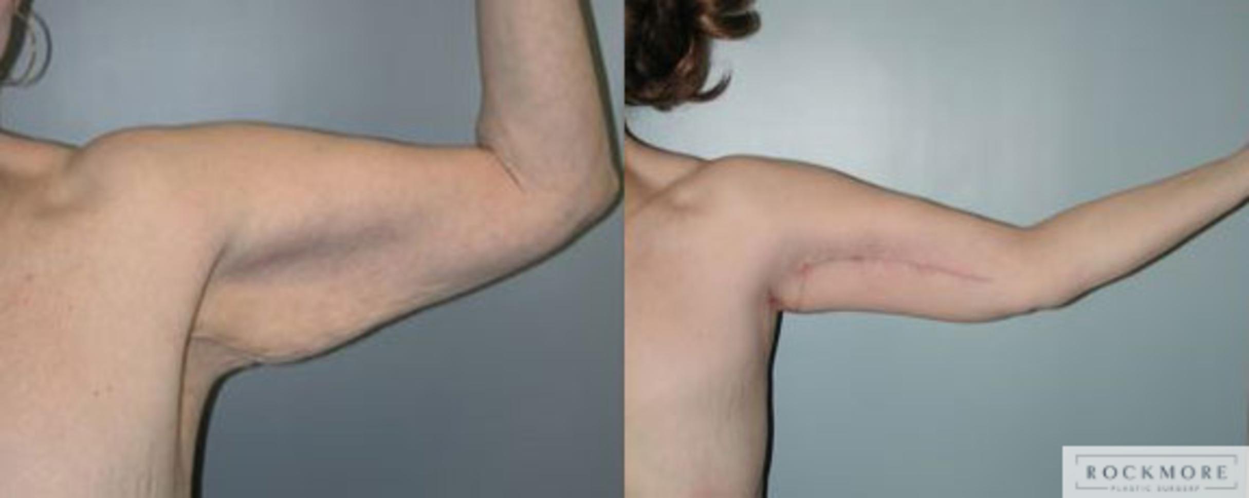 Before & After Arm Lift Case 97 View #3 View in Albany & Latham, New York