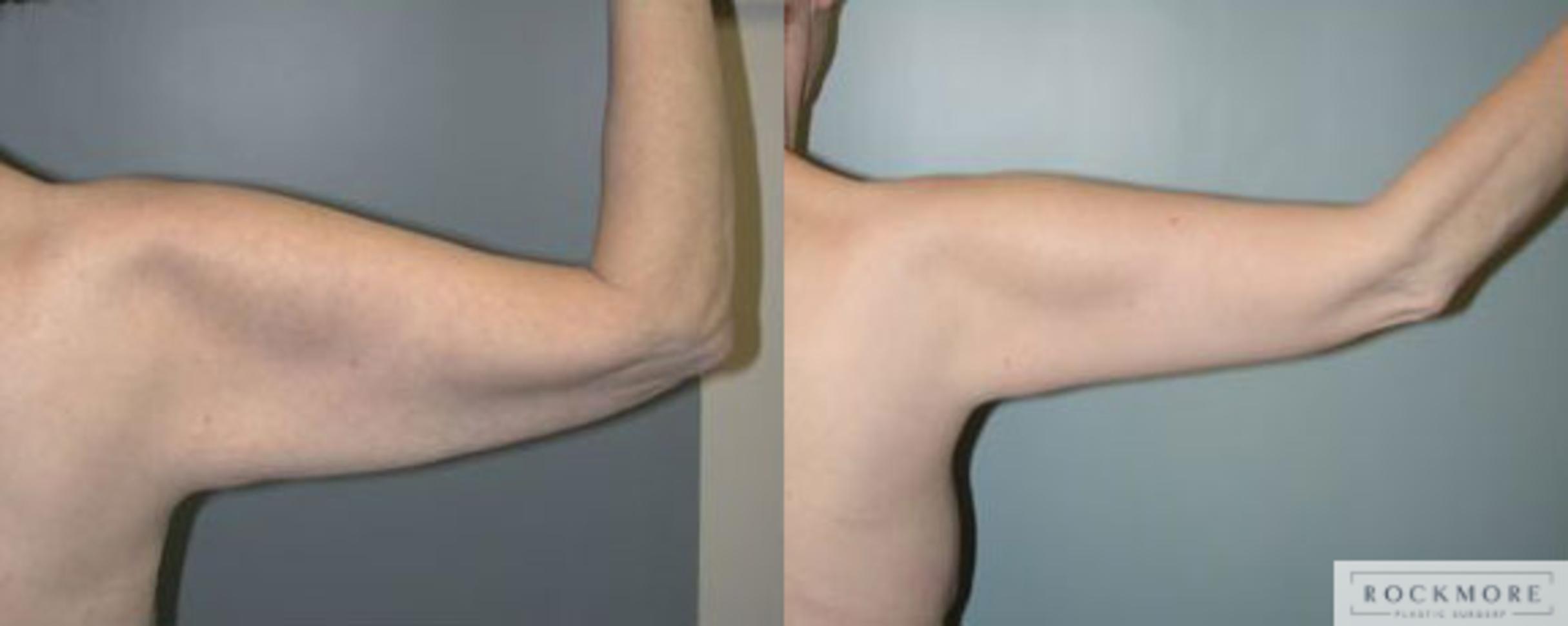 Before & After Arm Lift Case 97 View #4 View in Albany & Latham, New York
