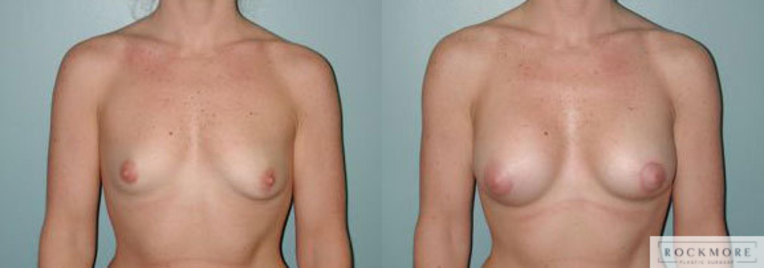 Before & After Asymmetric Breasts Case 114 View #1 View in Albany & Latham, New York