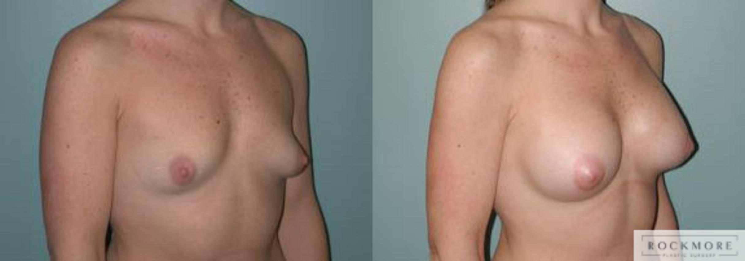 Before & After Asymmetric Breasts Case 114 View #2 View in Albany & Latham, New York