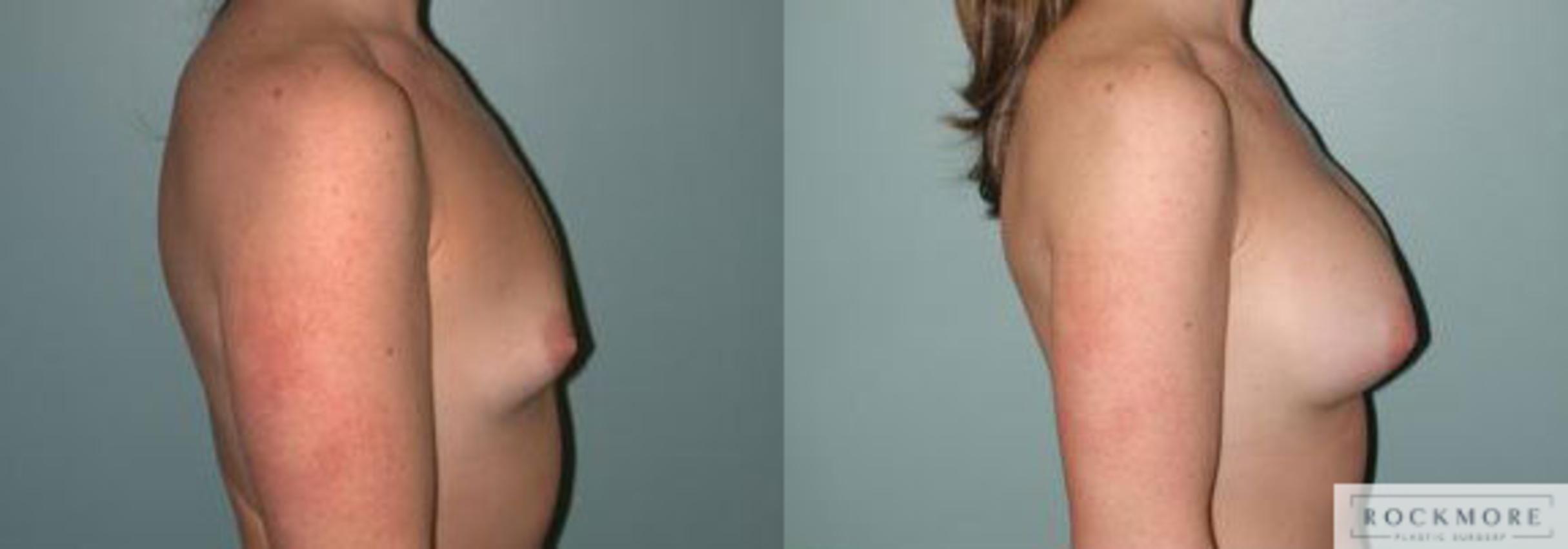 Before & After Asymmetric Breasts Case 114 View #3 View in Albany & Latham, New York