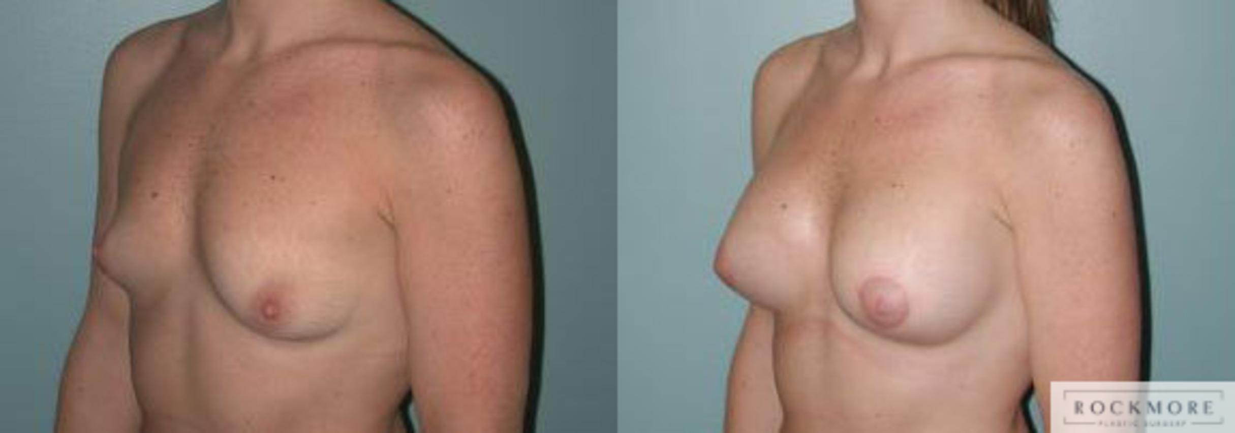 Before & After Asymmetric Breasts Case 114 View #4 View in Albany & Latham, New York