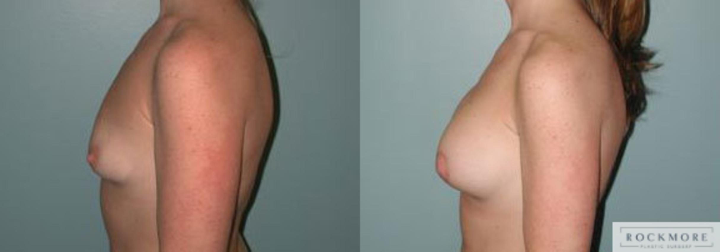 Before & After Asymmetric Breasts Case 114 View #5 View in Albany & Latham, New York