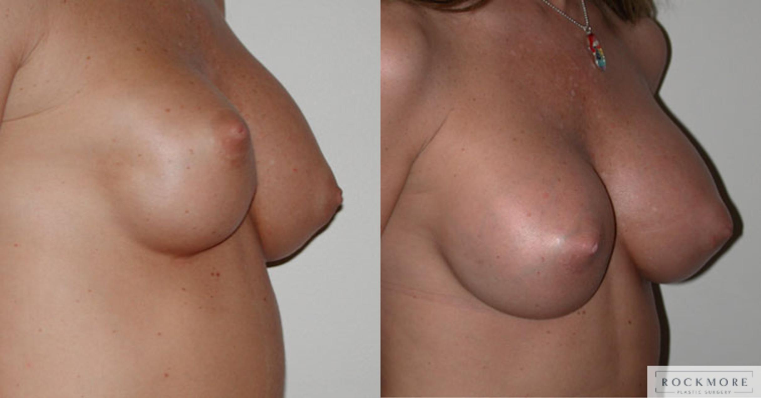 Before & After Asymmetric Breasts Case 47 View #2 View in Albany & Latham, New York