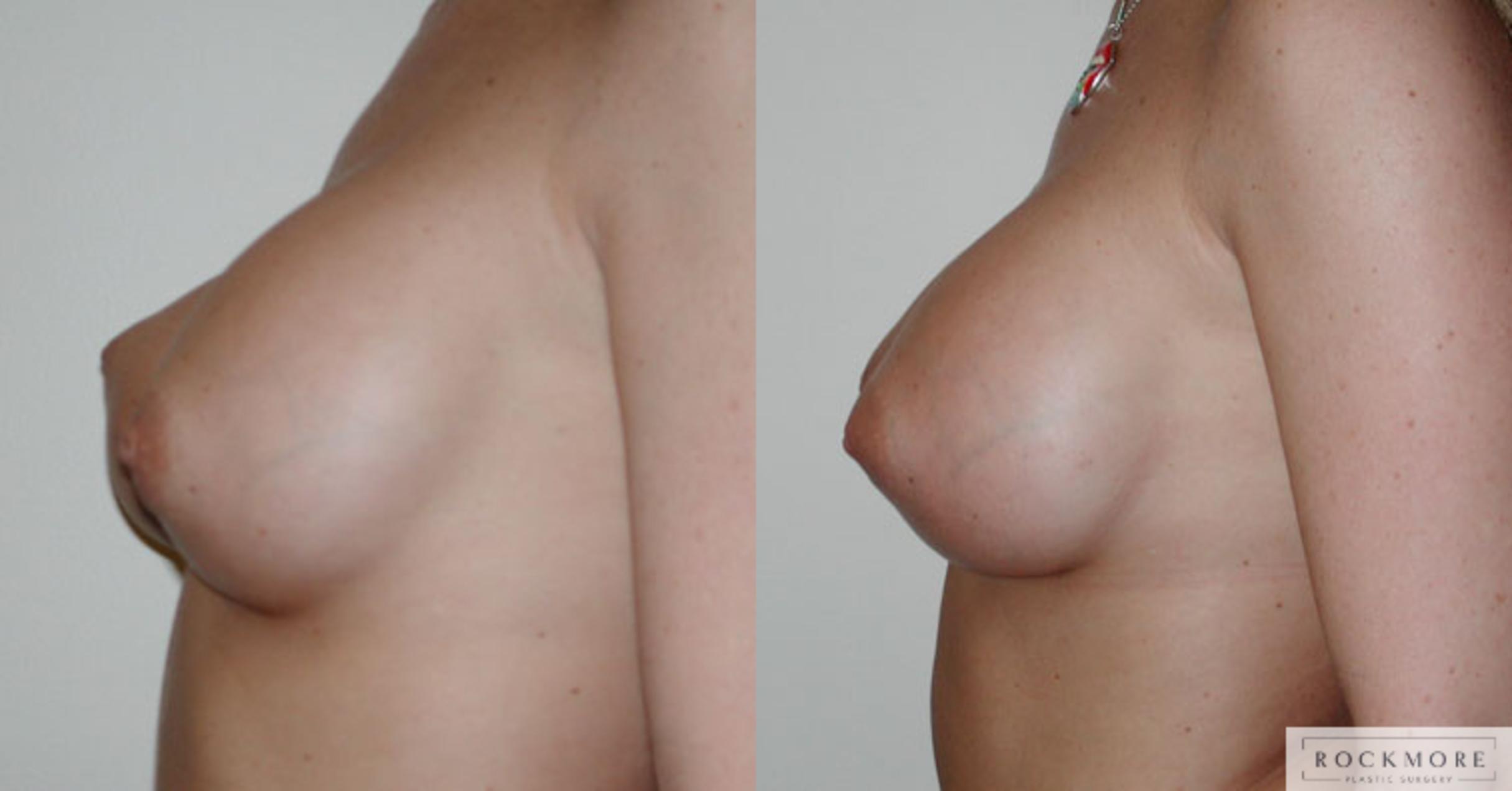 Before & After Asymmetric Breasts Case 47 View #3 View in Albany & Latham, New York