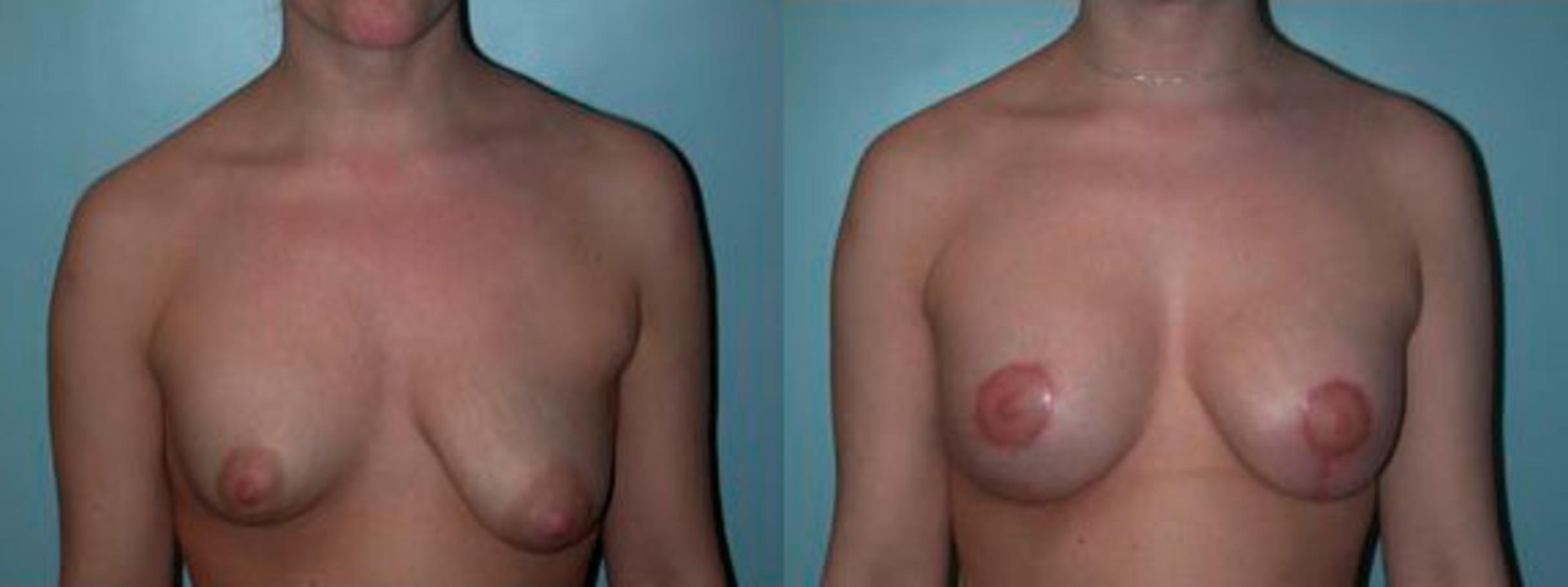 Before & After Asymmetric Breasts Case 79 View #1 View in Albany, Latham & Saratoga, New York