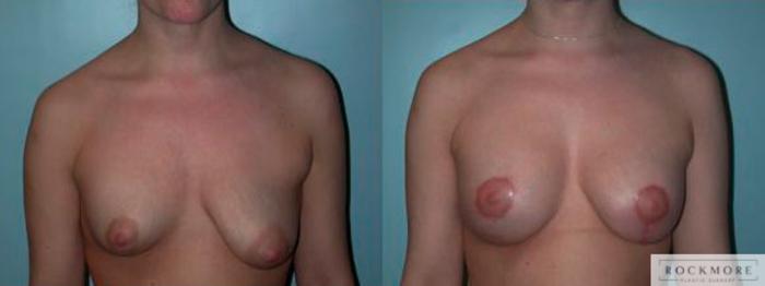 Before & After Asymmetric Breasts Case 79 View #1 View in Albany & Latham, New York