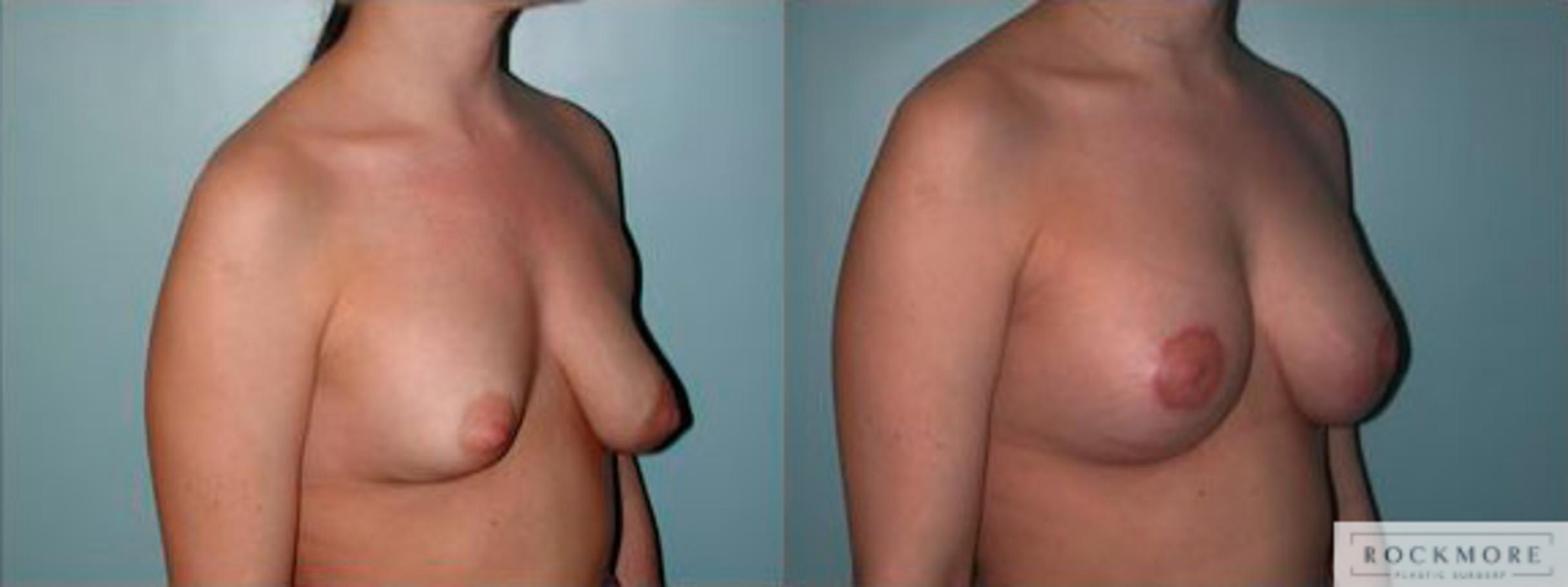 Before & After Asymmetric Breasts Case 79 View #2 View in Albany & Latham, New York