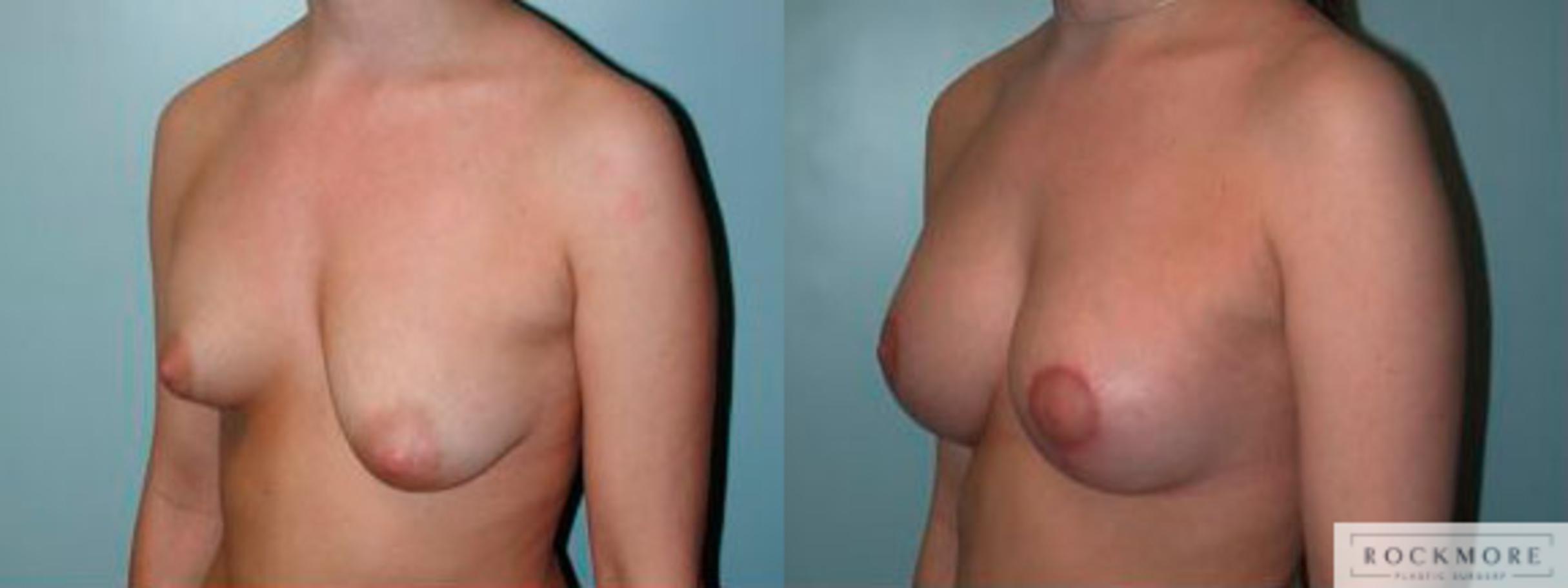 Before & After Asymmetric Breasts Case 79 View #3 View in Albany & Latham, New York
