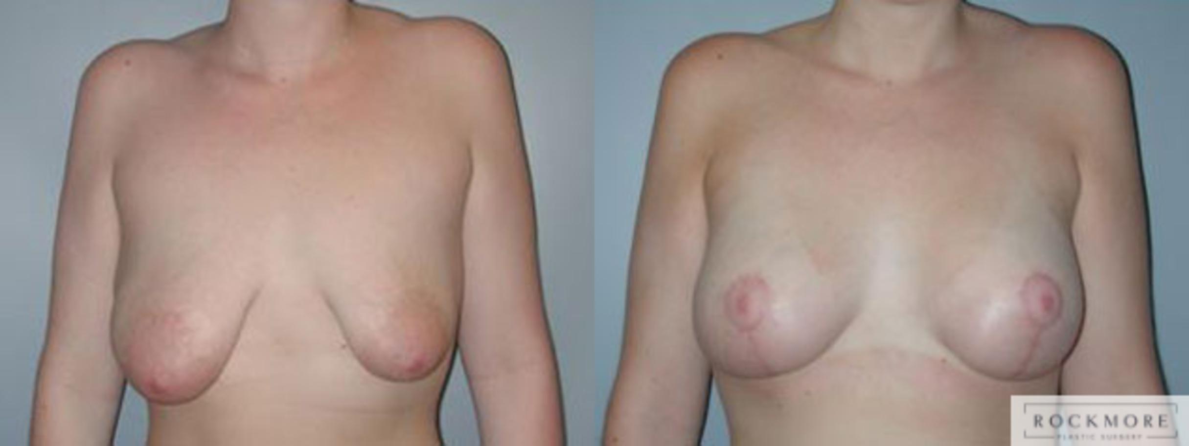 Before & After Asymmetric Breasts Case 86 View #1 View in Albany & Latham, New York