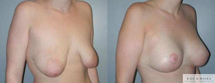 Before & After Asymmetric Breasts Case 86 View #2 View in Albany & Latham, New York