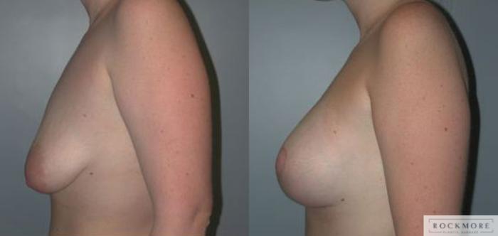 Before & After Asymmetric Breasts Case 86 View #3 View in Albany & Latham, New York