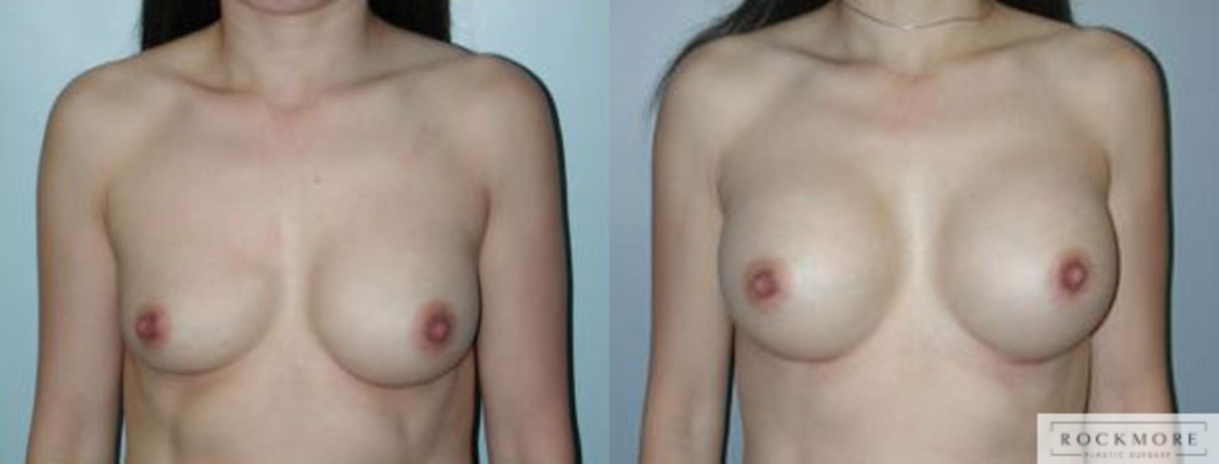 Before & After Asymmetric Breasts Case 88 View #1 View in Albany & Latham, New York
