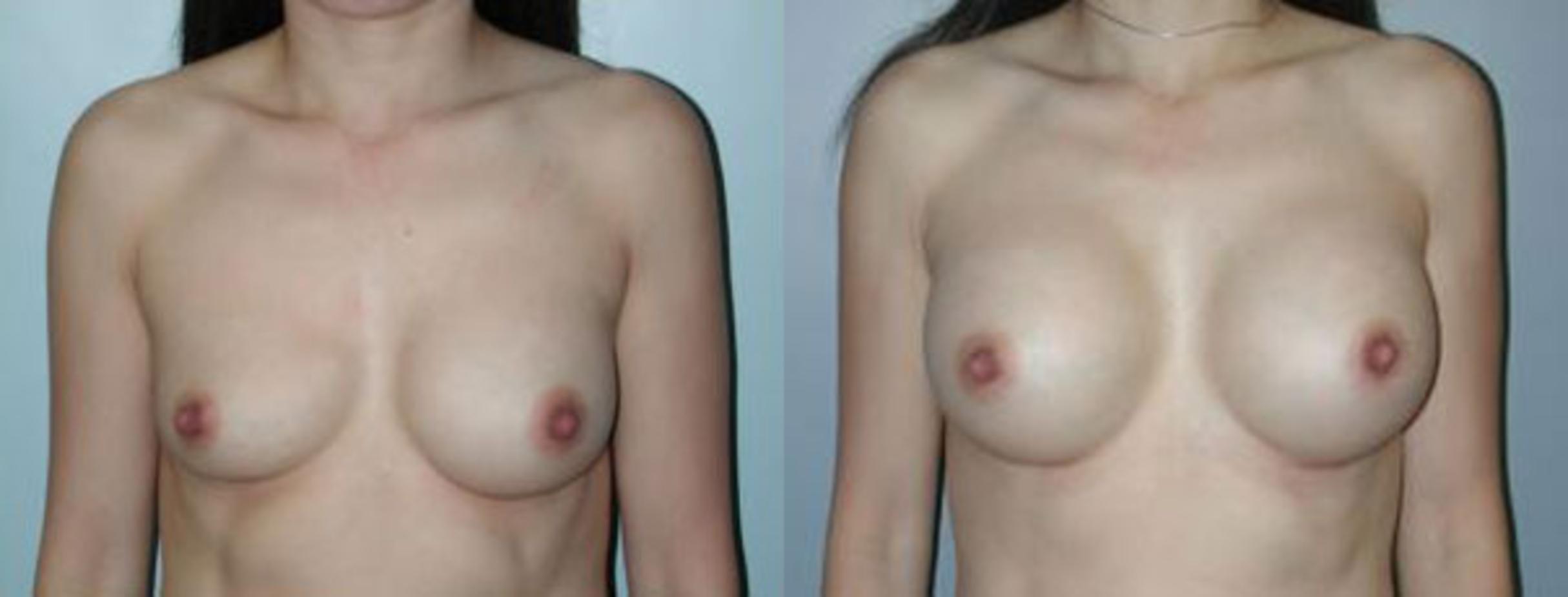 Before & After Asymmetric Breasts Case 88 View #1 View in Albany & Latham, New York