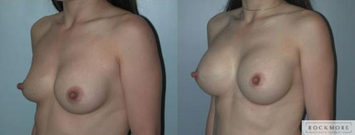 Before & After Asymmetric Breasts Case 88 View #2 View in Albany & Latham, New York