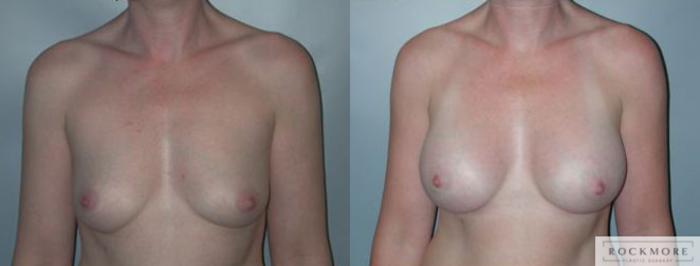 Before & After Asymmetric Breasts Case 89 View #1 View in Albany & Latham, New York
