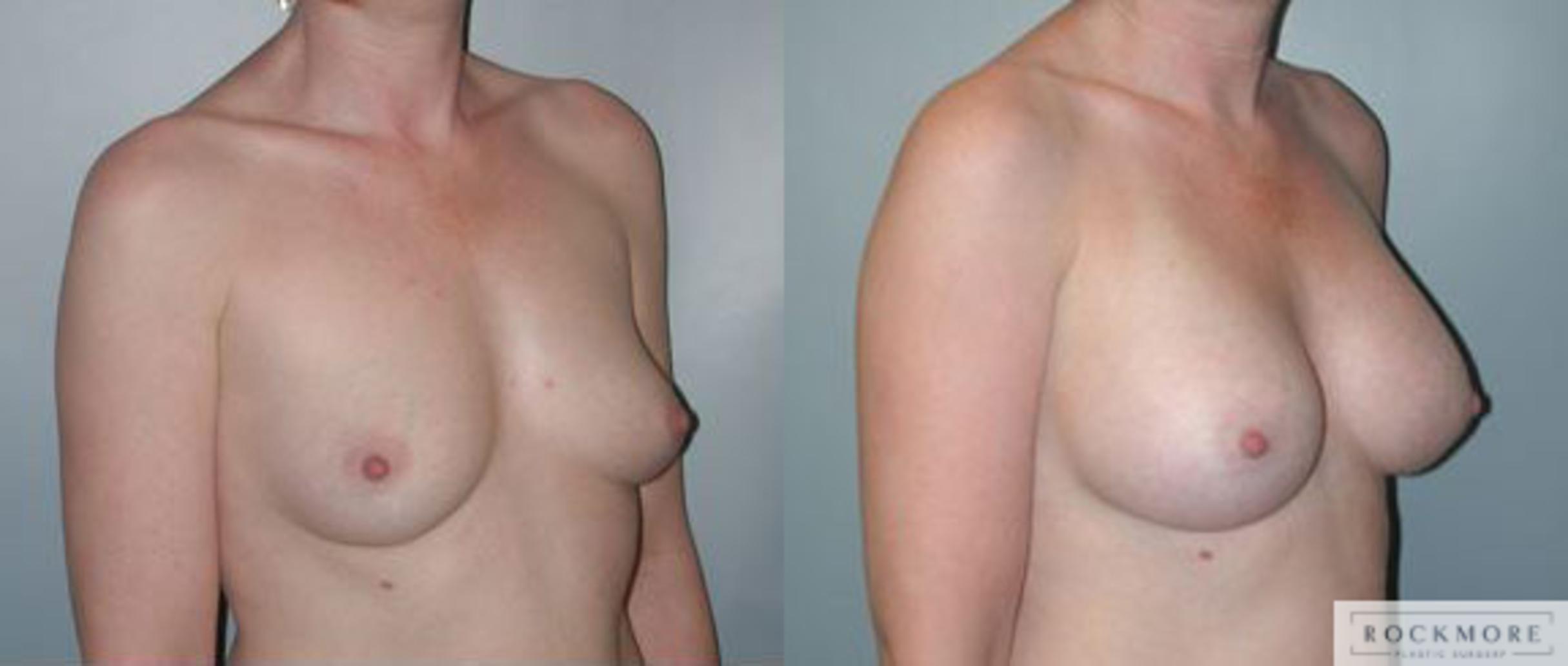 Before & After Asymmetric Breasts Case 89 View #2 View in Albany & Latham, New York