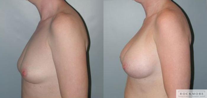 Before & After Asymmetric Breasts Case 89 View #3 View in Albany & Latham, New York