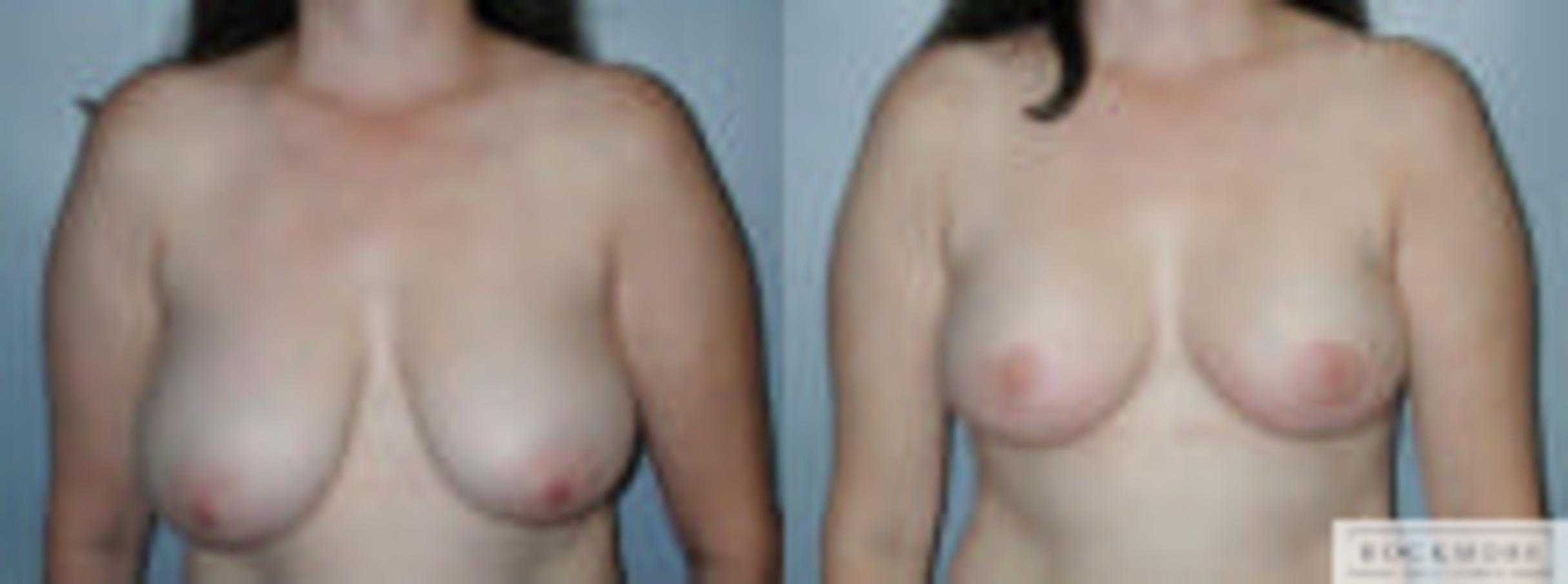 Before & After Asymmetric Breasts Case 93 View #1 View in Albany & Latham, New York