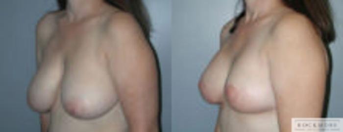 Before & After Asymmetric Breasts Case 93 View #2 View in Albany & Latham, New York