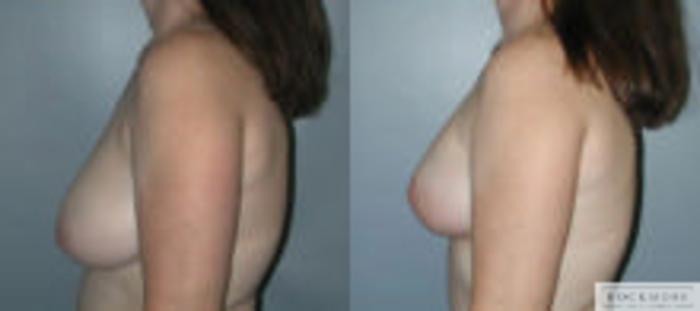 Before & After Asymmetric Breasts Case 93 View #3 View in Albany & Latham, New York