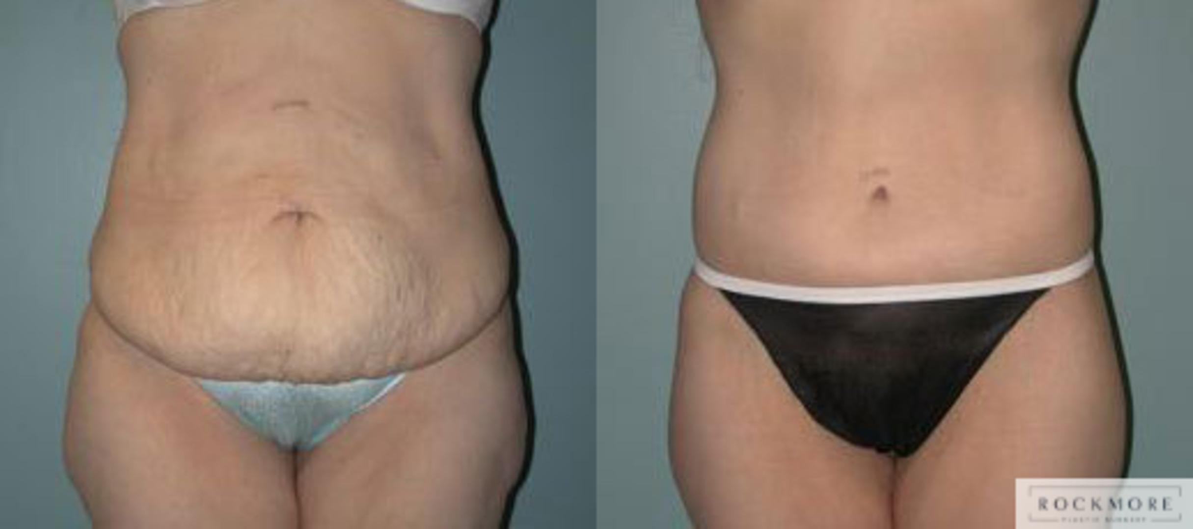 Before & After Body Contouring After Weight Loss Case 116 View #1 View in Albany & Latham, New York
