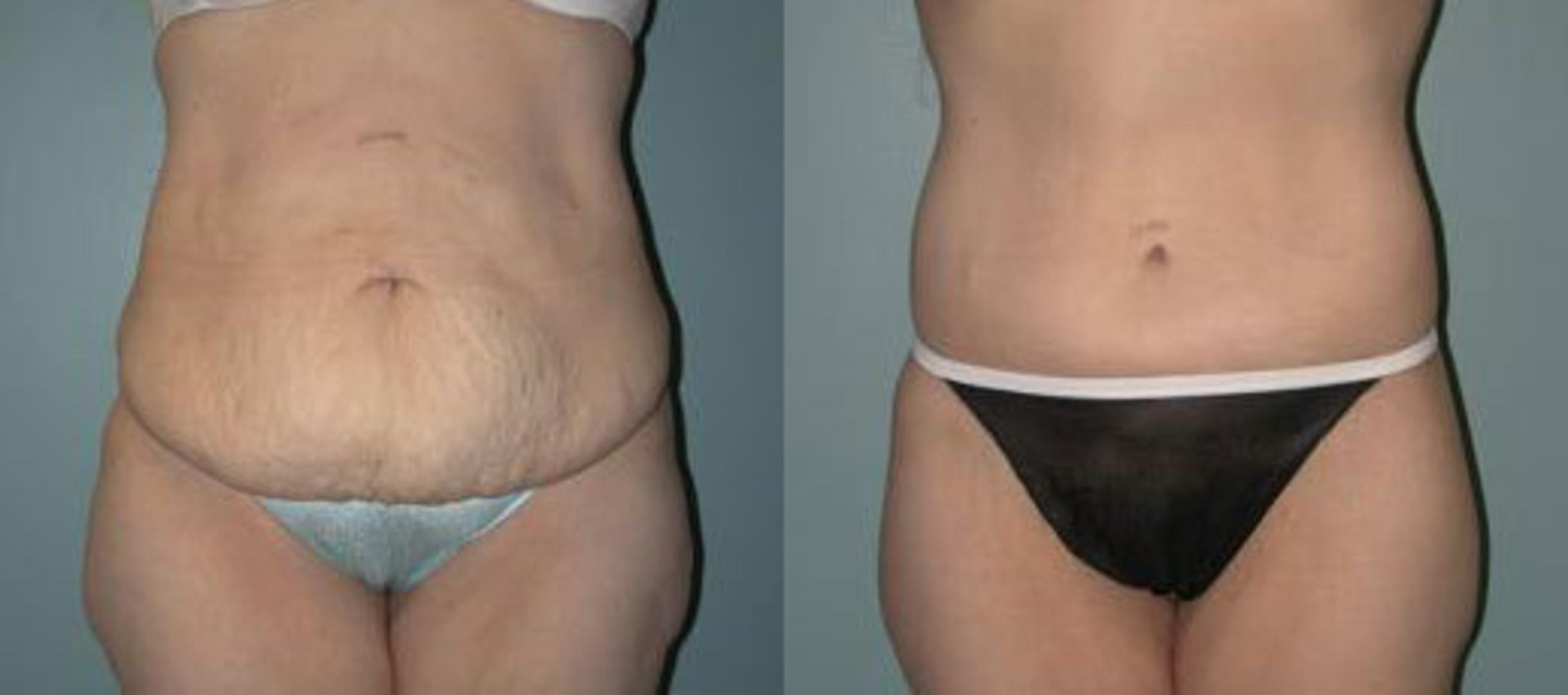 Body Contouring After Weight Loss Before and After Pictures Case 377, Albany & Latham, New York