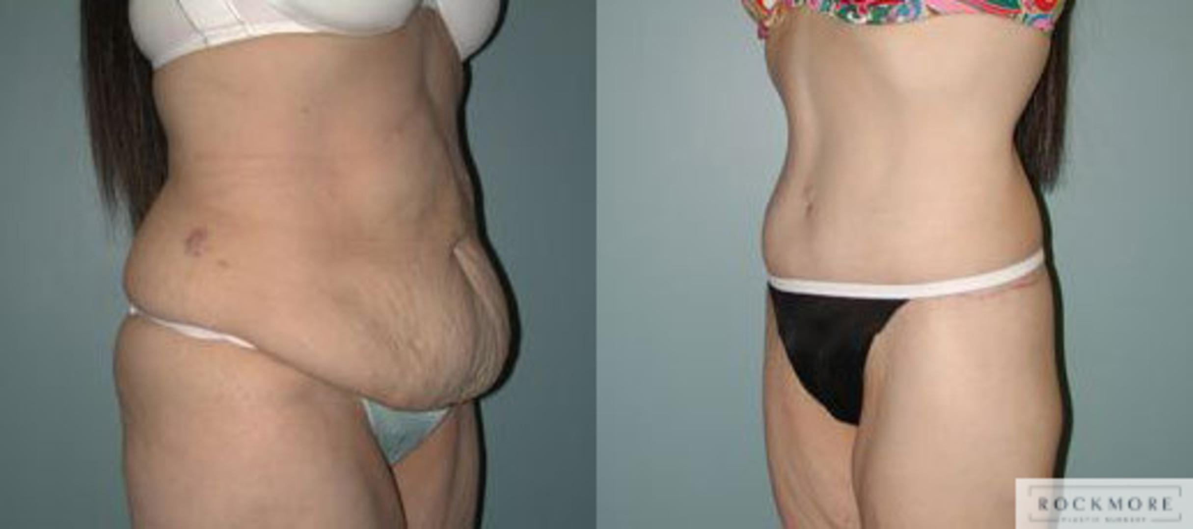 Before & After Body Contouring After Weight Loss Case 116 View #2 View in Albany & Latham, New York