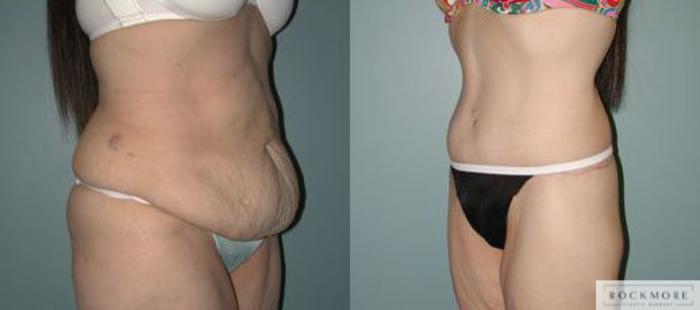 Before & After Body Contouring After Weight Loss Case 116 View #2 View in Albany & Latham, New York
