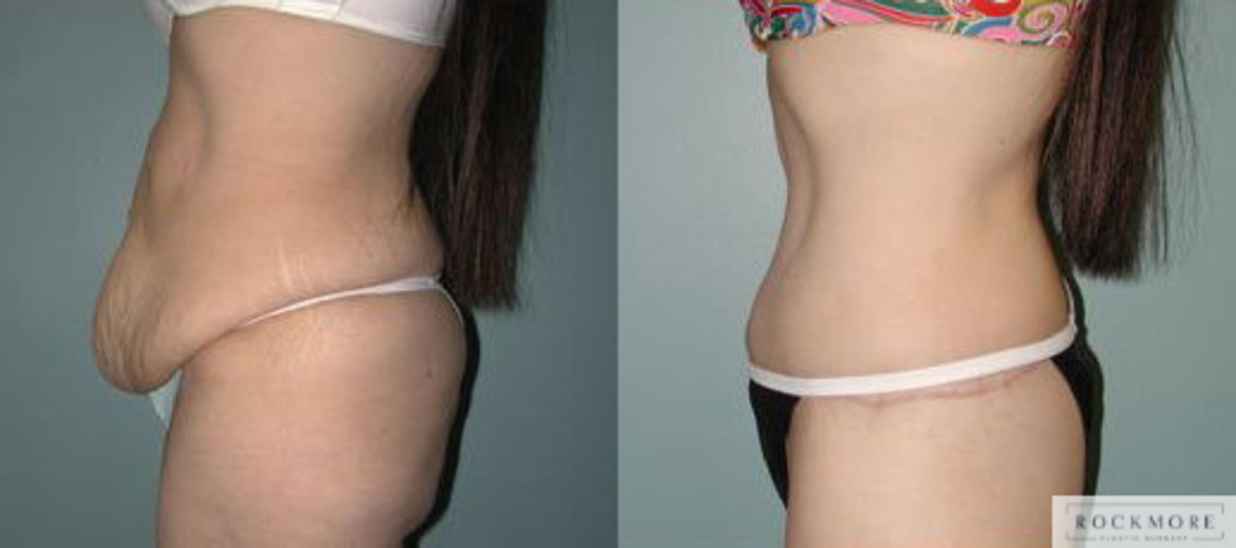 Before & After Body Contouring After Weight Loss Case 116 View #3 View in Albany & Latham, New York