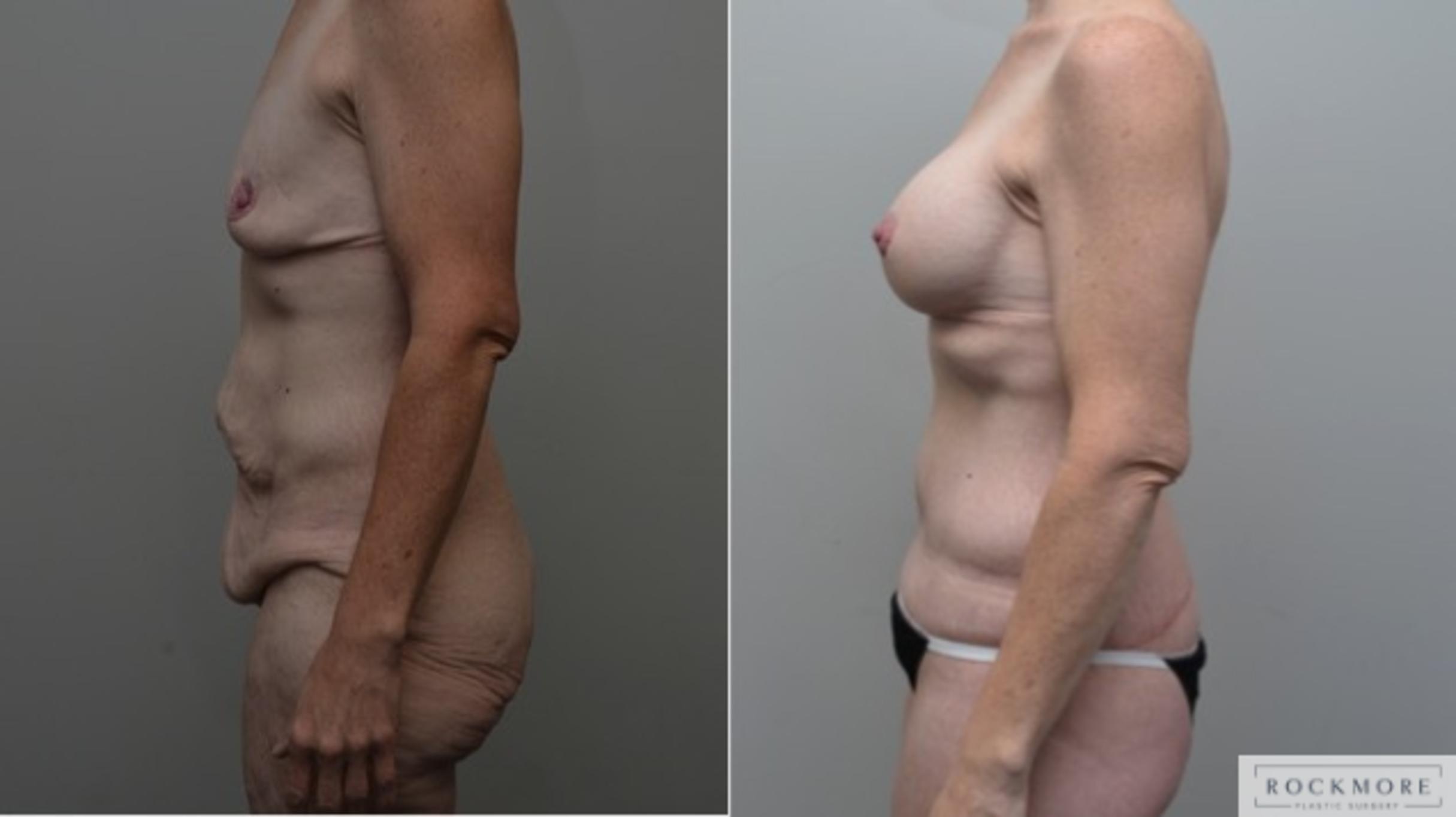 Before & After Body Contouring After Weight Loss Case 274 View #2 View in Albany & Latham, New York