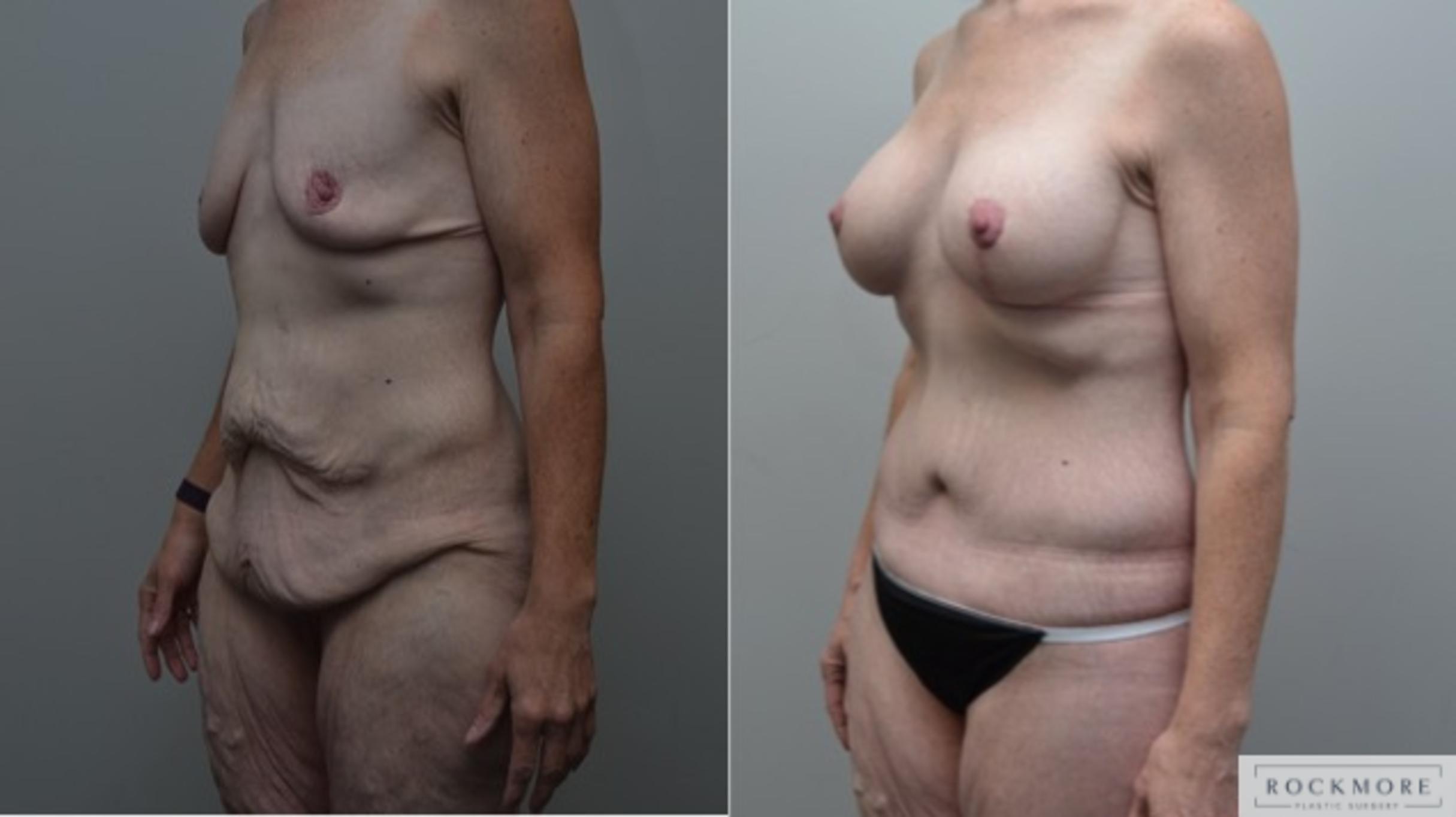 Before & After Body Contouring After Weight Loss Case 274 View #3 View in Albany & Latham, New York