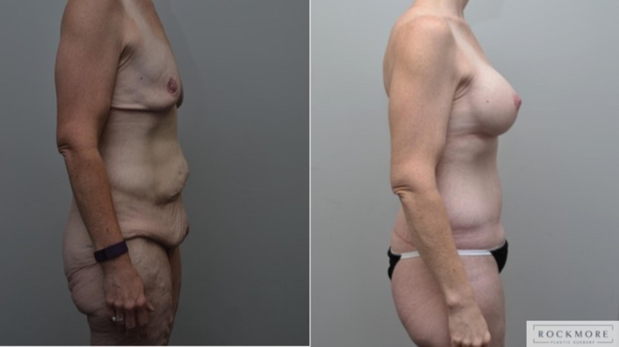 Before & After Body Contouring After Weight Loss Case 274 View #5 View in Albany & Latham, New York