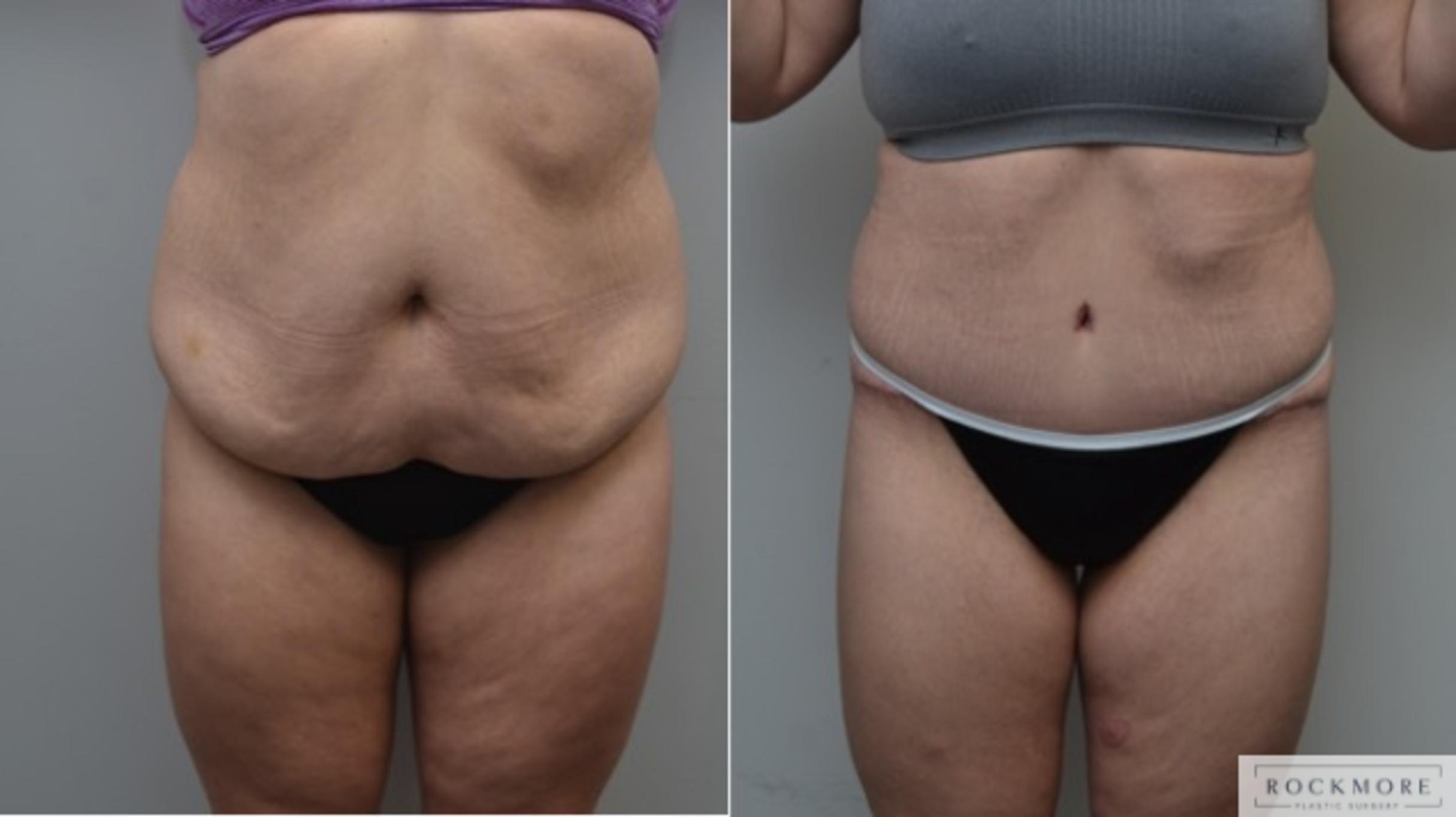 Before & After Body Contouring After Weight Loss Case 278 View #1 View in Albany & Latham, New York
