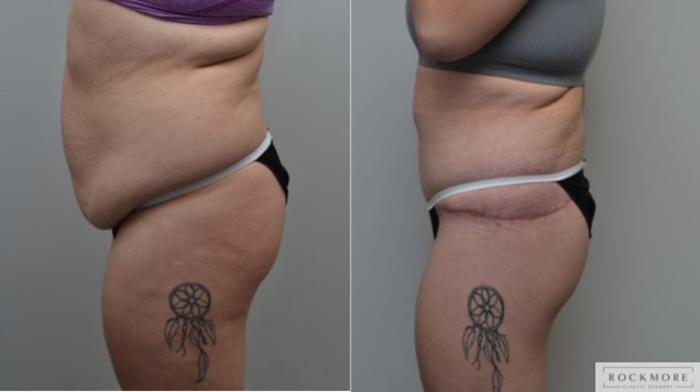 Before & After Body Contouring After Weight Loss Case 278 View #2 View in Albany & Latham, New York