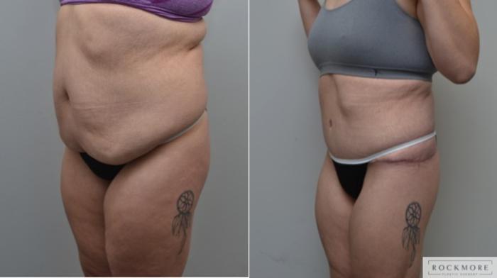 Before & After Body Contouring After Weight Loss Case 278 View #3 View in Albany & Latham, New York