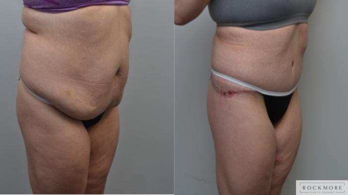 Before & After Body Contouring After Weight Loss Case 278 View #5 View in Albany & Latham, New York